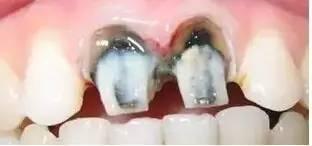 烤瓷牙拆除视频全过程,专业操作解析